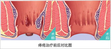 得了痔瘡怎么辦